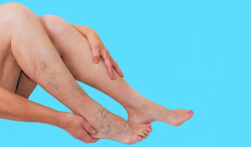 Everyday Habits That Improve Vein Health and Reduce Discomfort