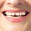 Financing Options to Help You Fix a Chipped Tooth Fast