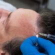 What-Are-the-Long-Term-Benefits-of-FUT-Hair-Transplants