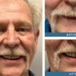 Recovery time after getting zygomatic implants