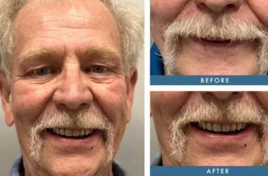 Recovery time after getting zygomatic implants