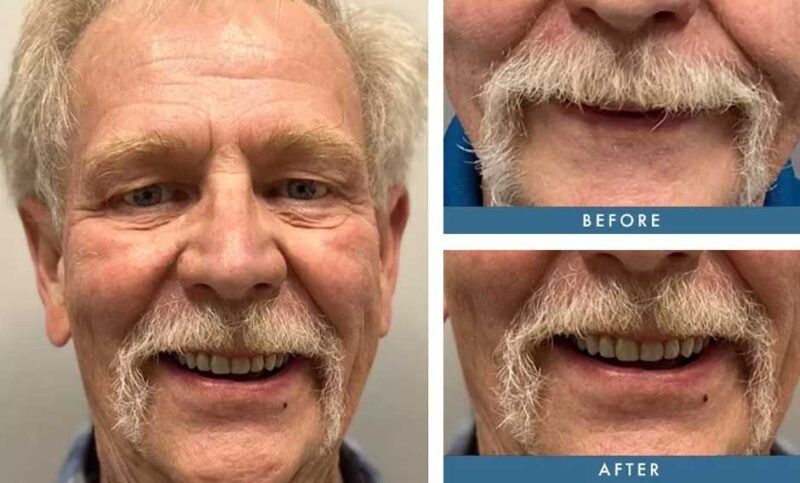 Recovery time after getting zygomatic implants