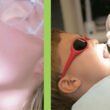 The Benefits of Using Fluoride Varnish Cups in Your Practice