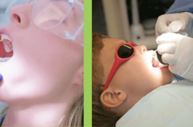 The Benefits of Using Fluoride Varnish Cups in Your Practice