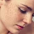 Does Hyperpigmentation Ever Really Go Away